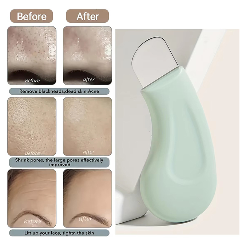 เครื่องมือกำจัดสิวเสี้ยนและสิว - Nasal Aspirator บทวิจารณ์และราคา